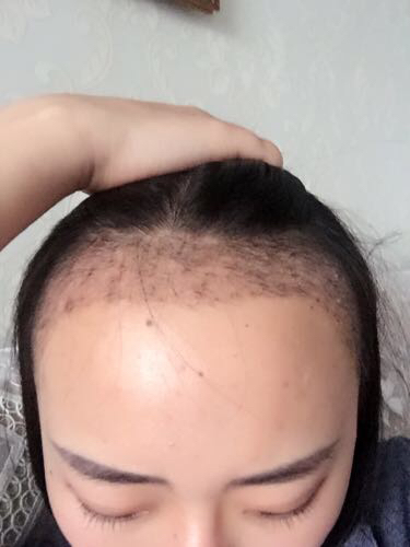 成都玉之光頭發(fā)移植 果杠杠的~