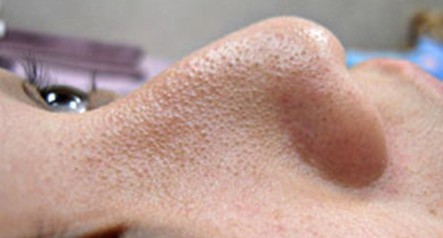 成都玉之光做了杏仁酸換膚 皮膚真的凈白無瑕了