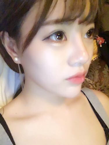 北京禾美嘉注射玻尿酸豐唇+豐臥蠶 讓我更美啦~