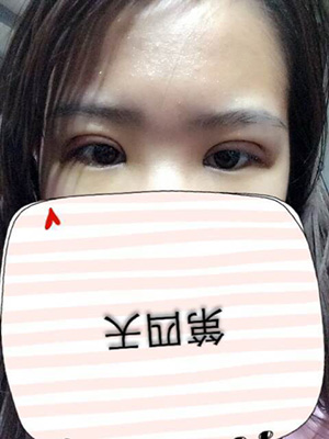 納米x雕雙眼皮15天了~ 我恢復的算快嗎