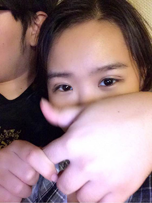 納米x雕雙眼皮15天了~ 我恢復的算快嗎