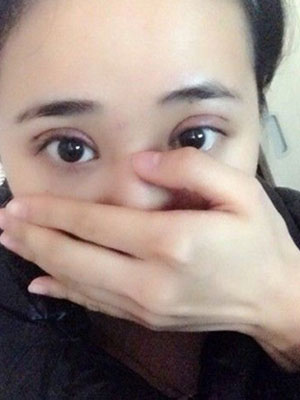北京常好麗格割雙眼皮一周啦~