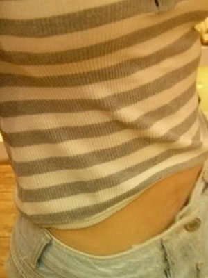 北京常好麗格腰腹吸脂后20天的感受 恢復日記來咯~