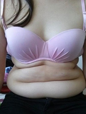 北京常好麗格腰腹吸脂后20天的感受 恢復日記來咯~