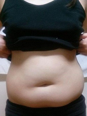 北京常好麗格腰腹吸脂后20天的感受 恢復日記來咯~