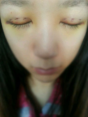 北北京常好麗格三點(diǎn)定位雙眼皮恢復(fù)一個(gè)月經(jīng)歷