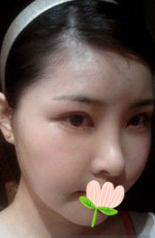 做了磨顴骨手術(shù)的我從小鴨子變成白天鵝 謝謝柳大烈教授