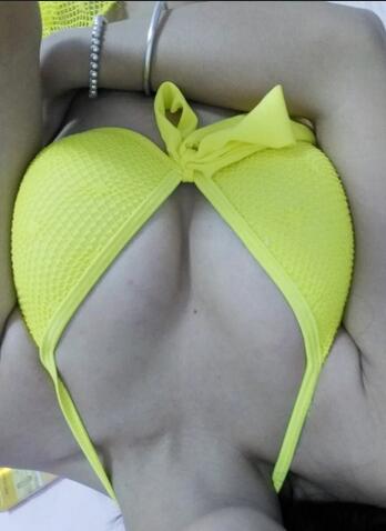 成都艾米麗自體脂肪豐胸前后對(duì)比