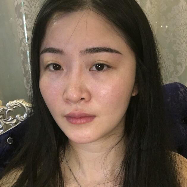 分享我的去胎記過程遺傳性雀斑終于被甩掉了