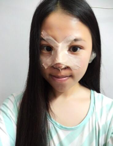 隆鼻整形真實(shí)恢復(fù)期圖片 隆鼻整形一個月了