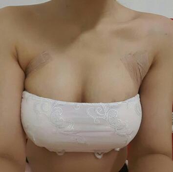 自體脂肪豐胸對比圖 抽脂隆胸十天