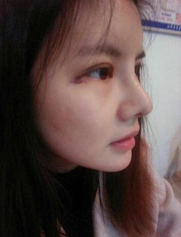 假體隆鼻兩個(gè)月后的感覺 隆鼻整形手術(shù)恢復(fù)日記