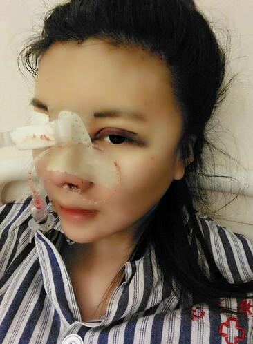 假體隆鼻兩個(gè)月后的感覺 隆鼻整形手術(shù)恢復(fù)日記