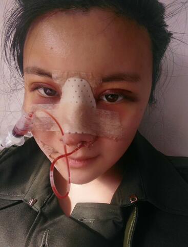 假體隆鼻兩個(gè)月后的感覺 隆鼻整形手術(shù)恢復(fù)日記