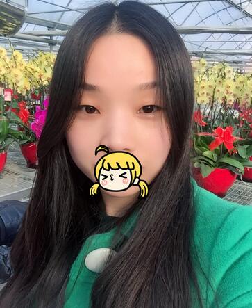 全切雙眼皮1個(gè)月過程圖