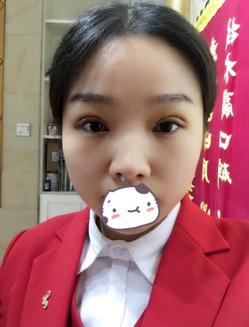全切雙眼皮1個(gè)月過程圖