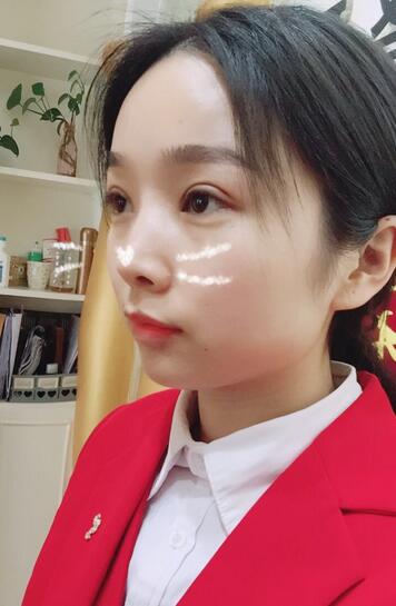 全切雙眼皮1個(gè)月過程圖
