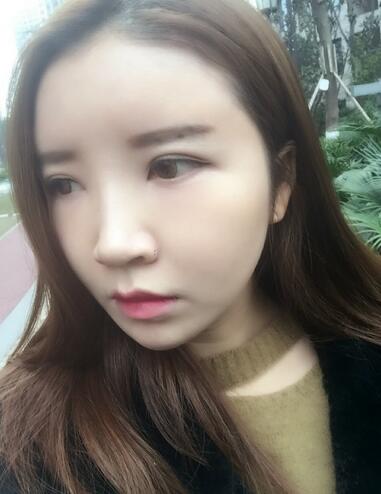 自體脂肪填充全臉1個月經歷