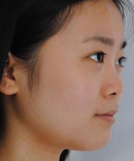 隆鼻整形日記 重慶鉑生硅膠隆鼻+耳軟骨鼻尖