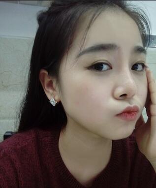 隆鼻整形日記 重慶鉑生硅膠隆鼻+耳軟骨鼻尖