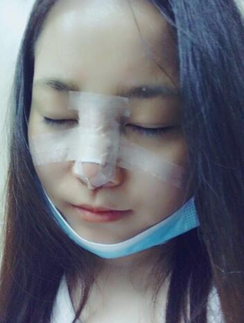 隆鼻整形日記 重慶鉑生硅膠隆鼻+耳軟骨鼻尖