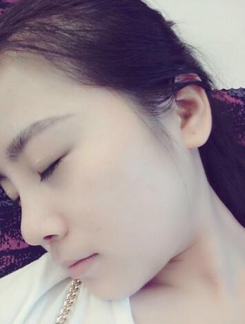 隆鼻整形日記 重慶鉑生硅膠隆鼻+耳軟骨鼻尖