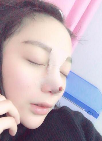 隆鼻修復(fù)術(shù)后恢復(fù)期經(jīng)歷
