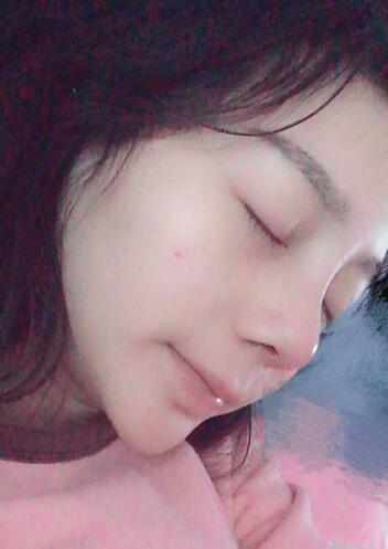 隆鼻修復(fù)術(shù)后恢復(fù)期經(jīng)歷