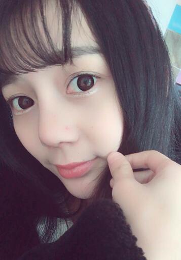 隆鼻修復(fù)術(shù)后恢復(fù)期經(jīng)歷