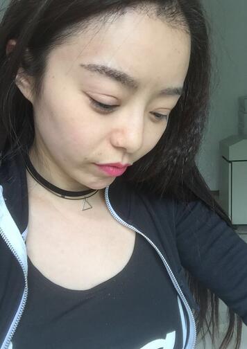 發(fā)際線調(diào)整案例分享 北京熙朵發(fā)際線+眉毛種植