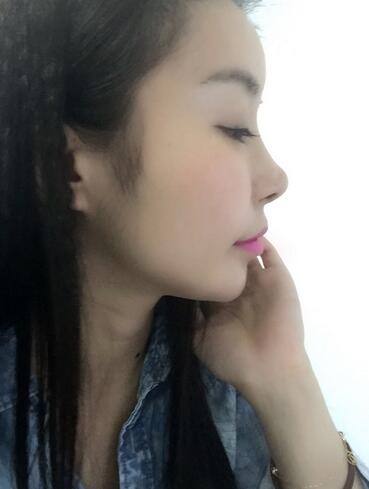 發(fā)際線調(diào)整案例分享 北京熙朵發(fā)際線+眉毛種植