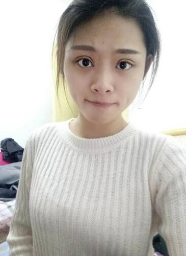 北京熙朵全切雙眼皮1個(gè)月恢復(fù)日記