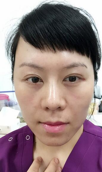 面部埋埋蛋白線.提升恢復過程分享
