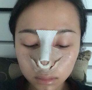 耳軟骨墊鼻尖+隆鼻+鼻翼縮小3個月了