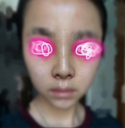 耳軟骨墊鼻尖+隆鼻+鼻翼縮小3個月了