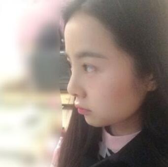 耳軟骨墊鼻尖+隆鼻+鼻翼縮小3個月了