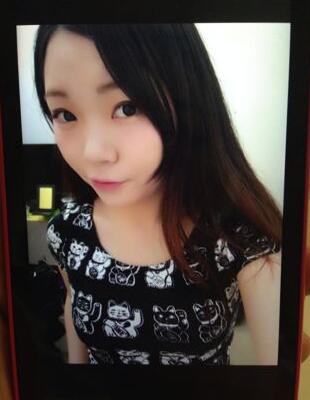 隆鼻整形真實(shí)恢復(fù)期圖片 硅膠隆鼻+鼻頭縮小