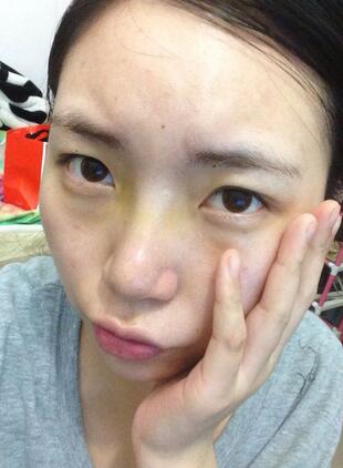 隆鼻整形真實(shí)恢復(fù)期圖片 硅膠隆鼻+鼻頭縮小