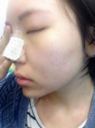 隆鼻整形真實(shí)恢復(fù)期圖片 硅膠隆鼻+鼻頭縮小