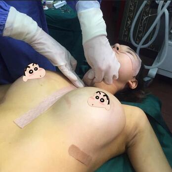 上海余天成自體脂肪隆胸70天恢復經歷