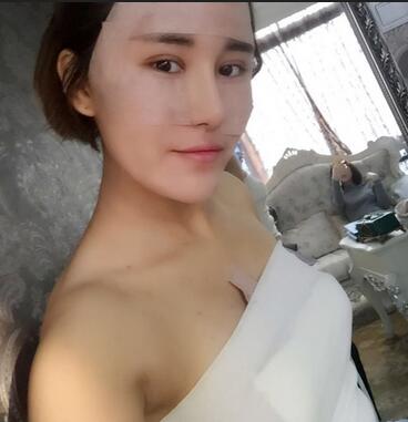 上海余天成自體脂肪隆胸70天恢復經歷