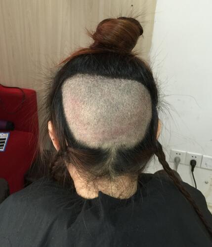 廣州倍生女性發(fā)際線調(diào)整案例