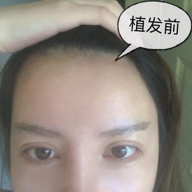 廣州倍生發(fā)際線種植前后對(duì)比照片