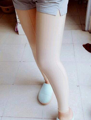 武漢詮美大腿吸脂后恢復過程