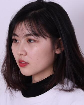 武漢西嬋康美玻尿酸隆鼻恢復過程圖