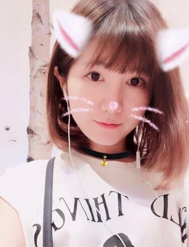 杭州王圣林全切雙眼皮恢復(fù)過程圖