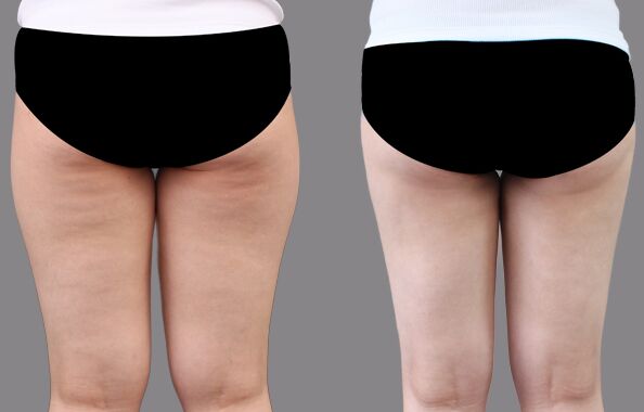 大腿吸脂減肥術(shù)后多久恢復(fù)，幾天能消腫