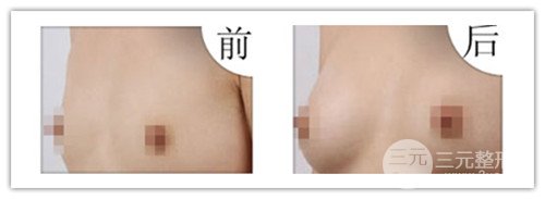 假體隆胸后可以運(yùn)動嗎，可以鍛煉嗎