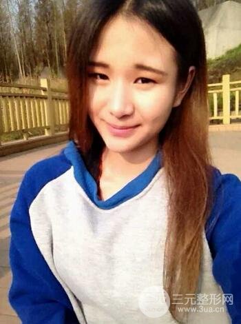 芭比雙眼皮多項整形前后對比照片 青島諾德曹繼武雙眼皮案例