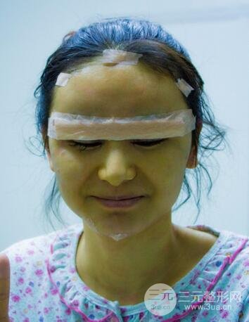 芭比雙眼皮多項整形前后對比照片 青島諾德曹繼武雙眼皮案例